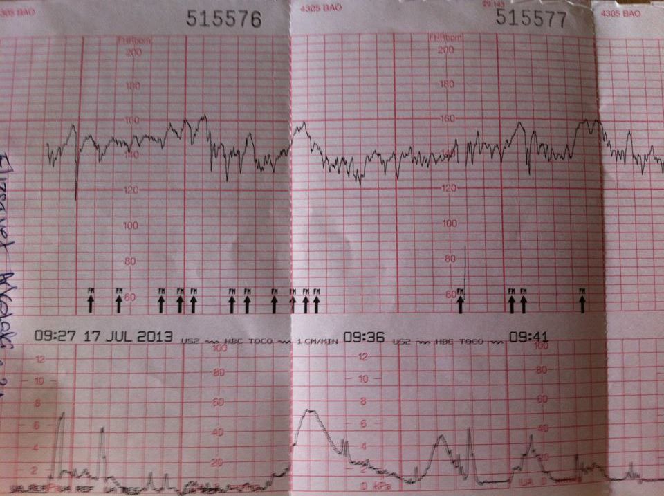 electronic fetal monitor