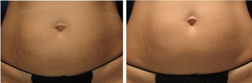 Sublative Stretch marks tummy (2)