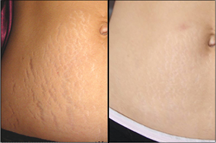 Sublative stretch marks tummy 2 (2)